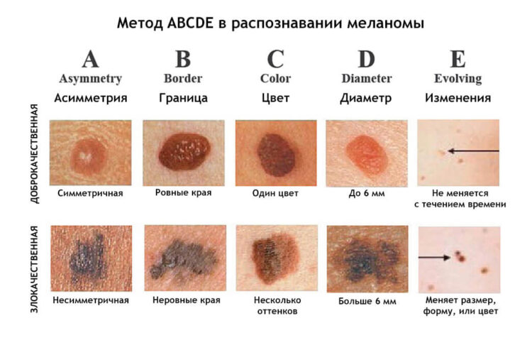 Признаки меланомы кожи фото начальная стадия фото