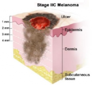 Четыре стадии меланомы