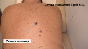 Меланома кожи