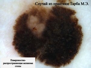 Меланома кожи