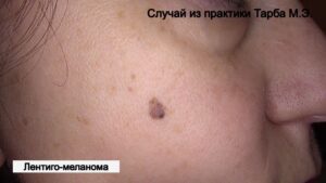 Меланома кожи