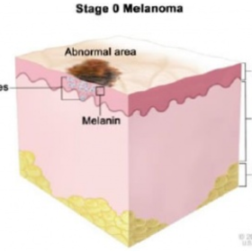 стадия меланомы 0