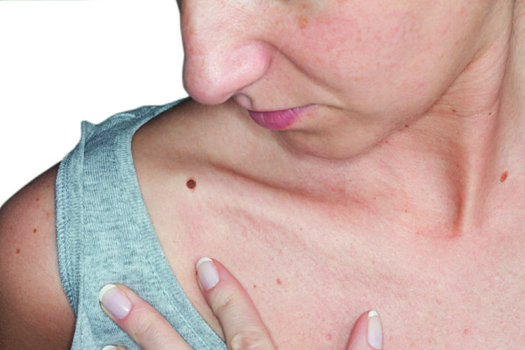 Меланома кожи: признаки меланомы, классификация, прогнозы и лечение