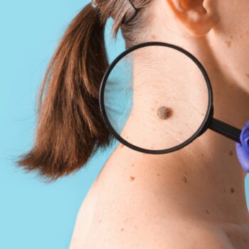 опухоли кожи