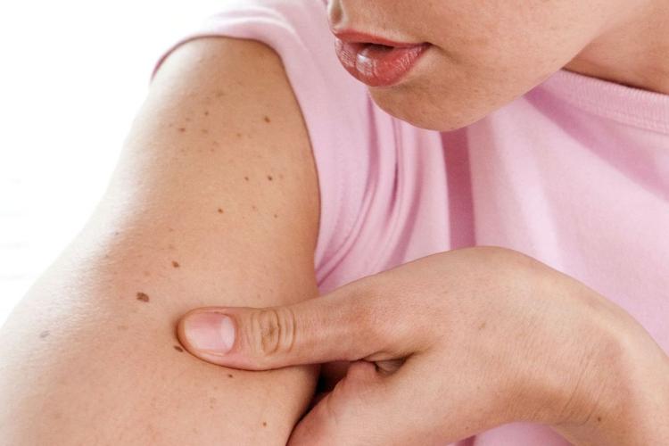 Как узнать свой риск развития рака кожи?