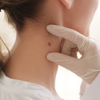 Лечение базалиомы