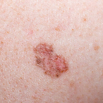 Treatment of basal cell carcinoma using the Mohs method