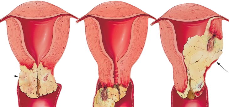 Воспалительные заболевания женских половых органов (вульвовагинит, кольпит)￼