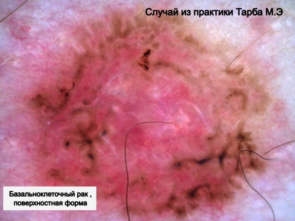 Базалиома (базальноклеточный рак кожи)