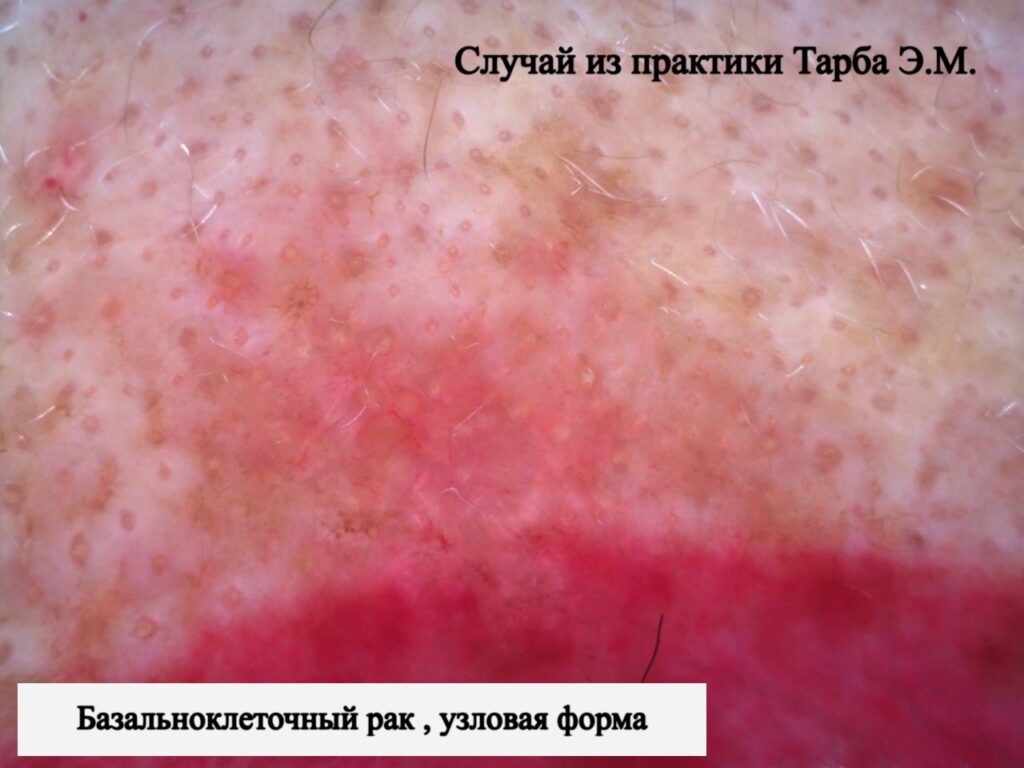 Базалиома (базальноклеточный рак кожи)
