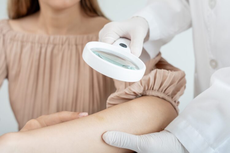 карцинома меркеля