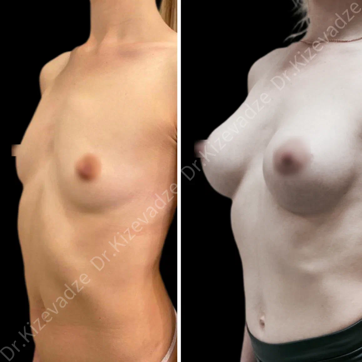 Увеличение груди круглыми имплантами