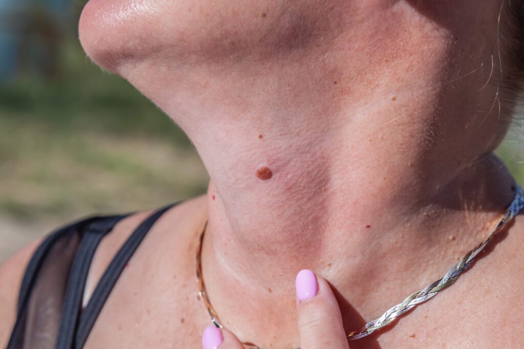 опасная родинка